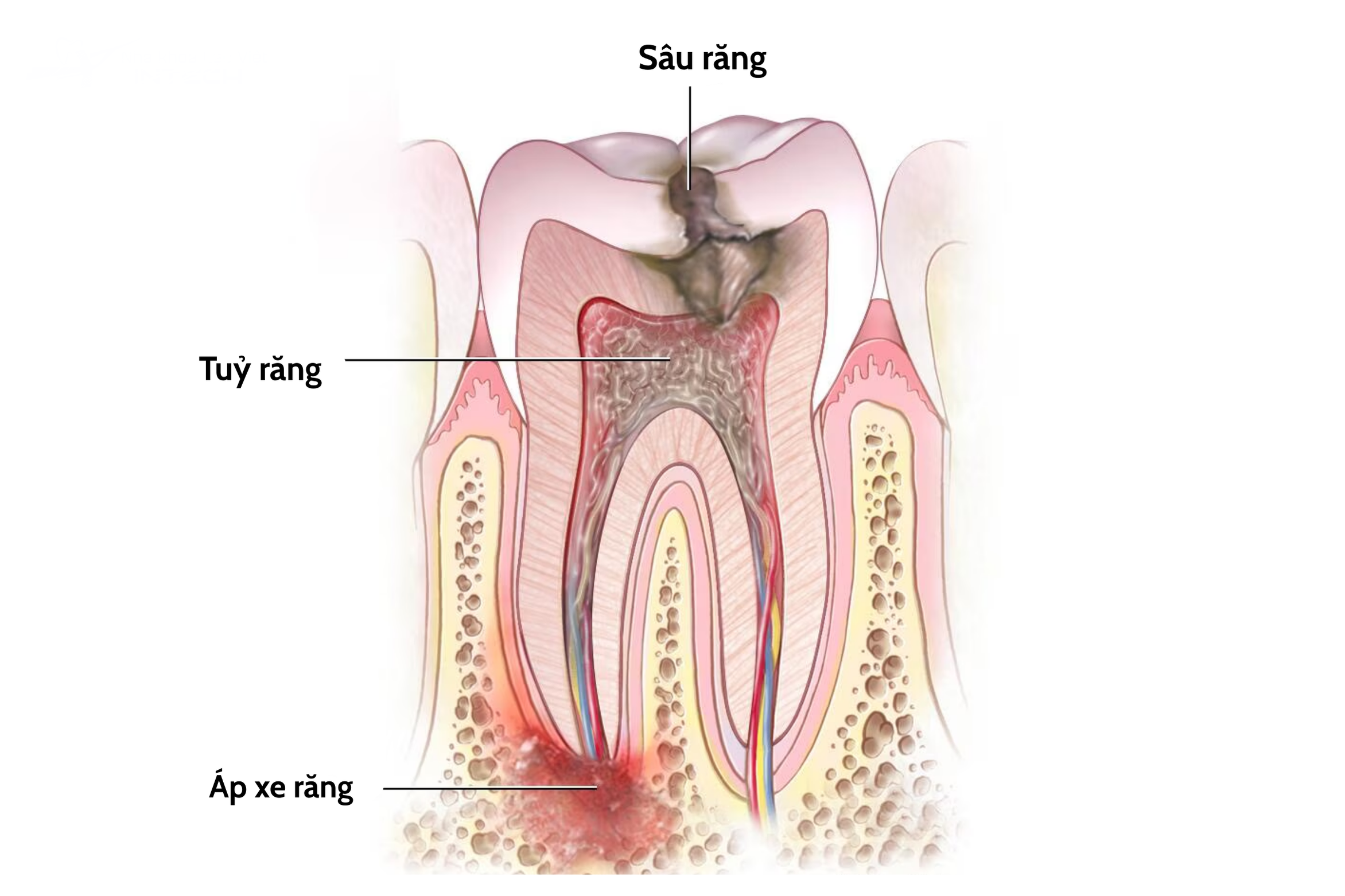 Cách áp xe răng dần hình thành
