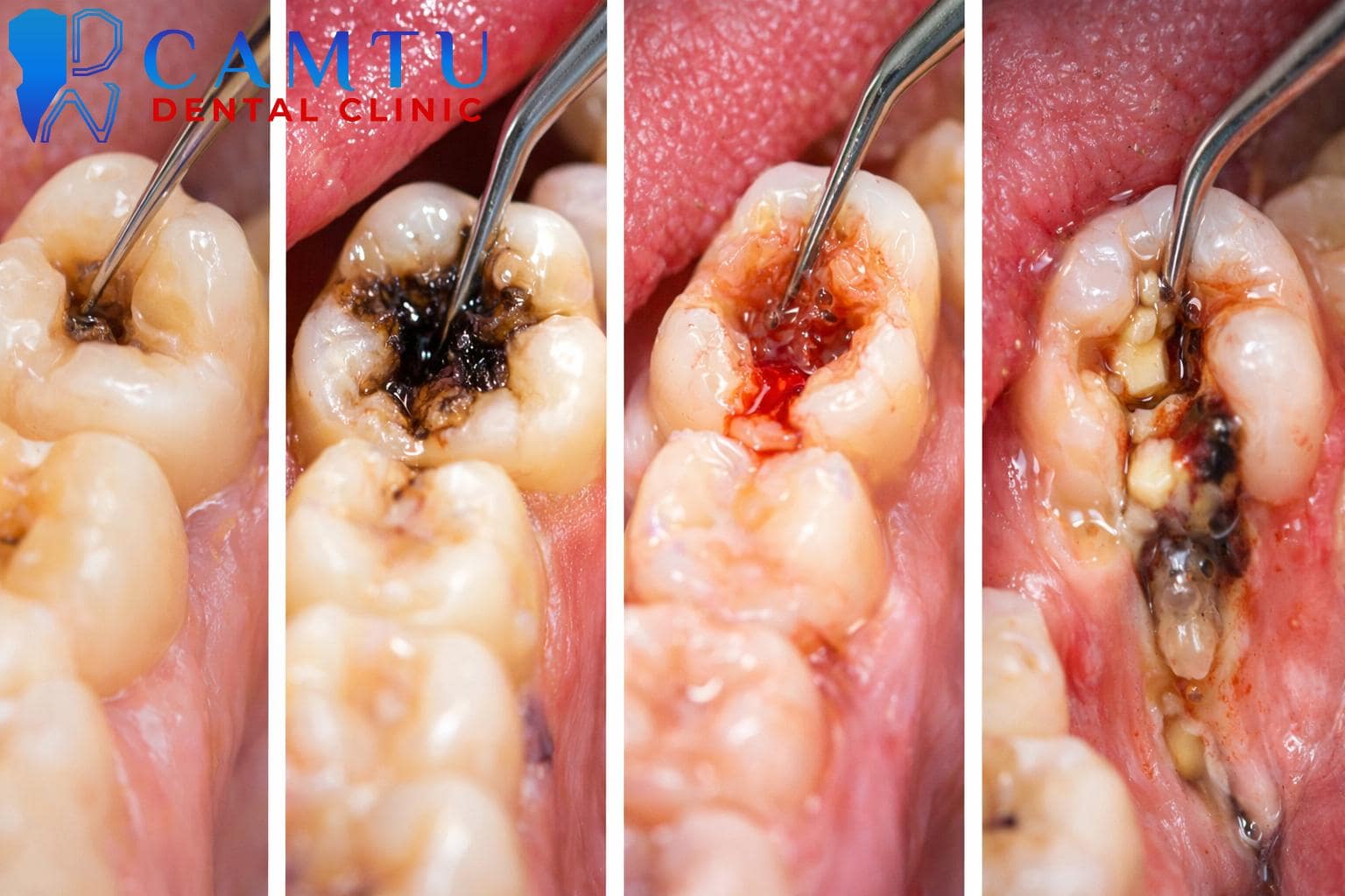 Dấu hiệu nhận biết viêm tủy răng qua từng giai đoạn