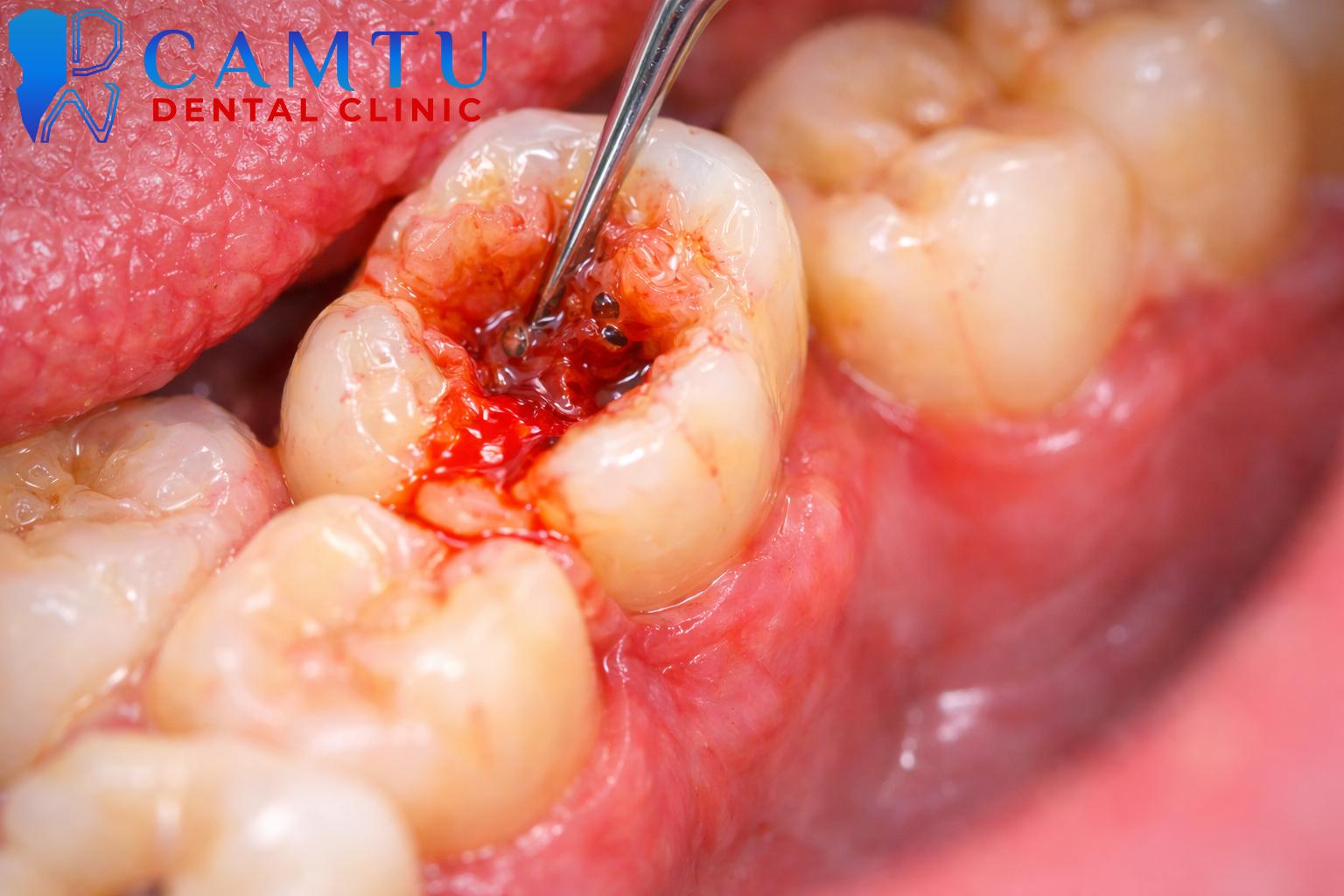 Giai đoạn viêm tủy cấp tính (Viêm tủy không hồi phục)