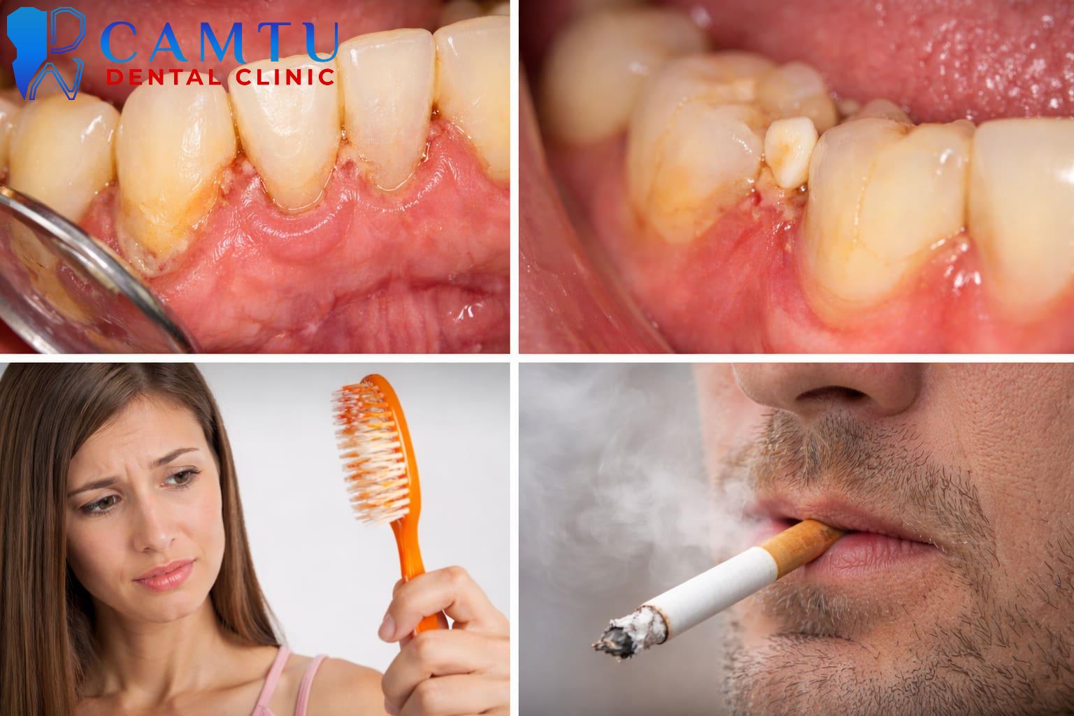 Nguyên nhân gây viêm nướu phổ biến