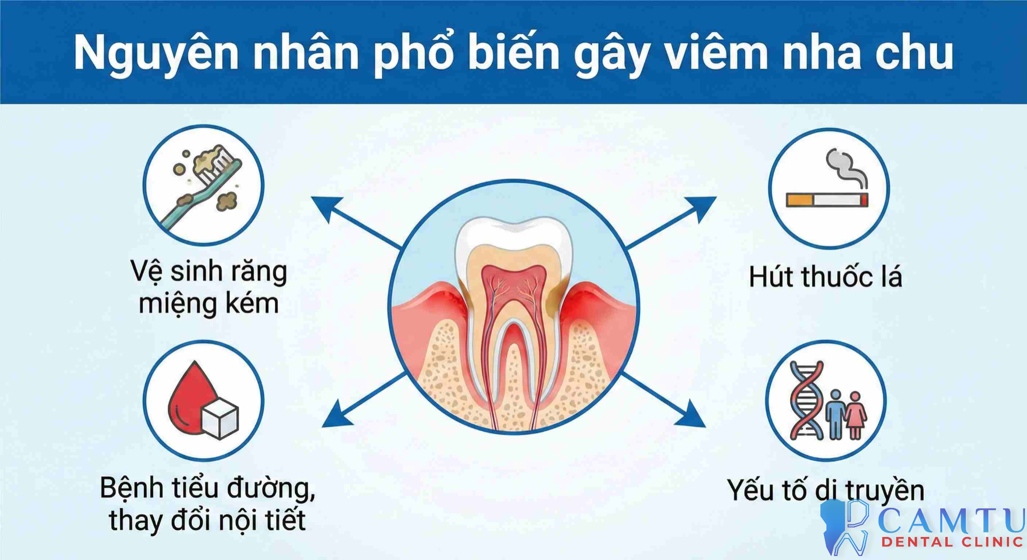 Các nguyên nhân gây ra viêm nha chu
