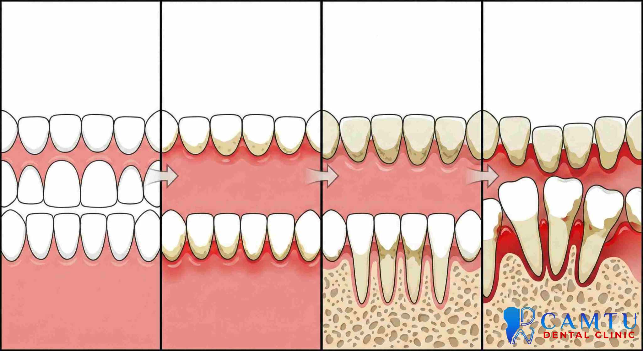 Các giai đoạn hình thành viêm nha chu