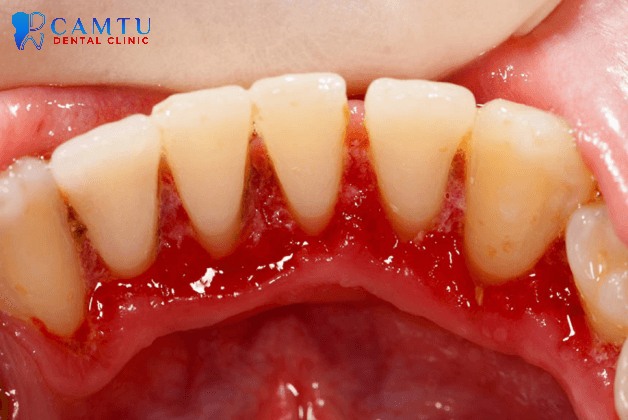 Chảy máu chân răng