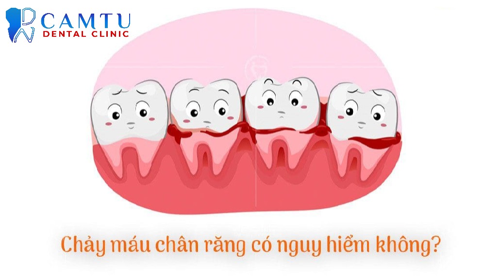 Chảy máu chân răng có nguy hiểm không?