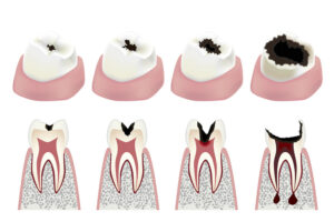 Các giai đoạn sâu răng từ nhẹ đến nặng