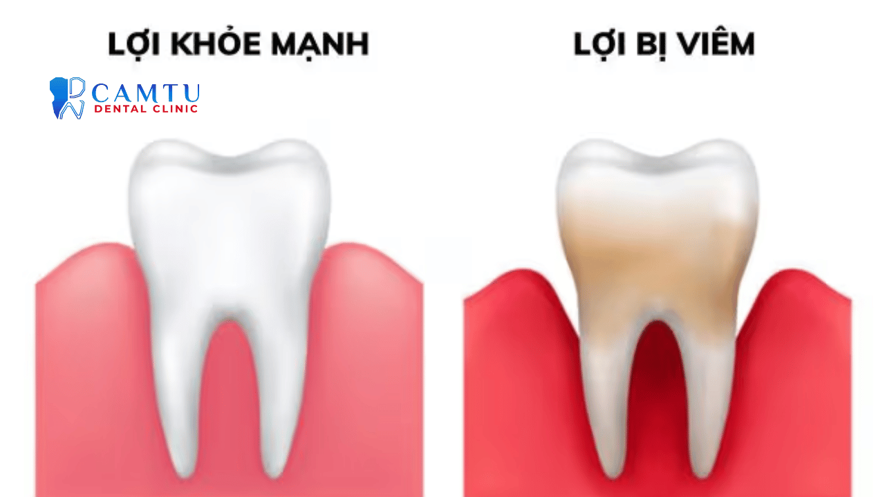 Viêm lợi có nhiều cấp độ khác nhau.