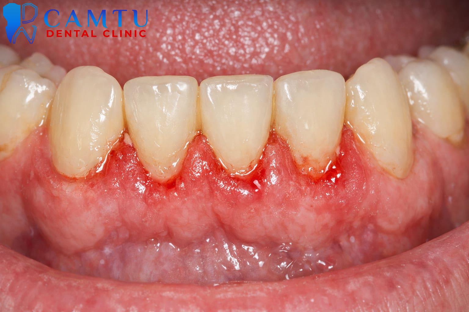 Viêm nướu là gì?