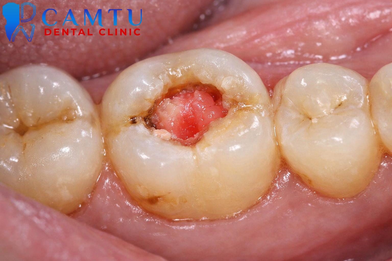 Viêm tủy có hồi phục (Tiền tủy viêm)