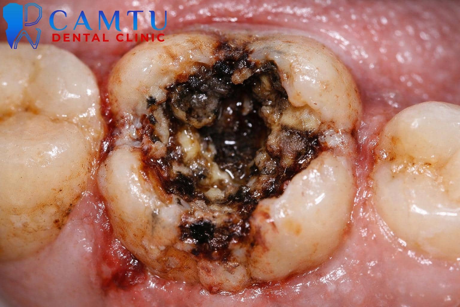 Viêm tủy hoại tử (Chết tủy)
