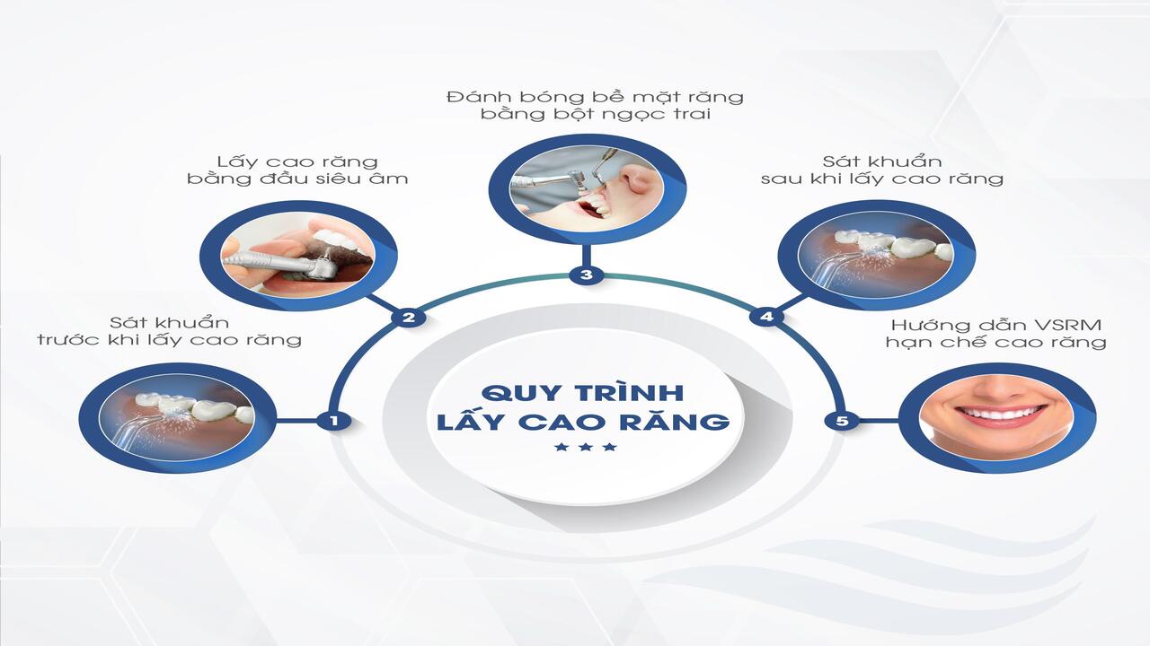 Các phương pháp lấy cao răng hiện nay