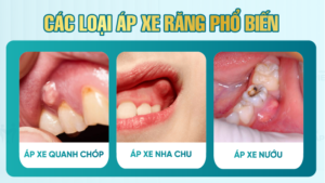 Các loại áp xe răng thường gặp