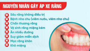 nguyên nhân gây ra áp xe răng là gì?