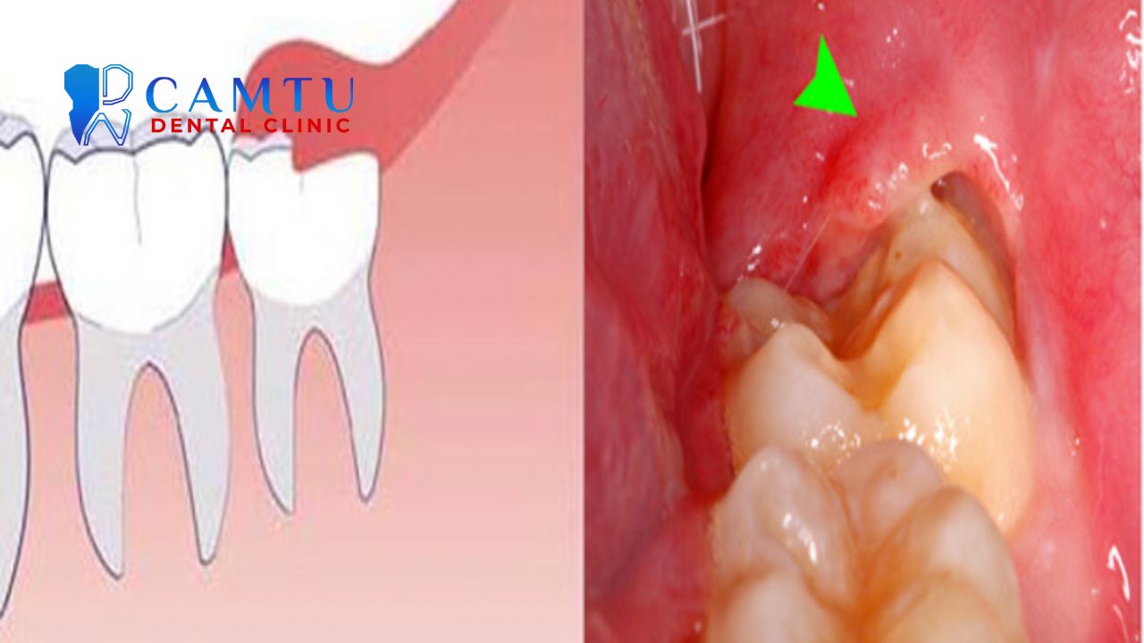 biến chứng sau khi nhổ răng khôn