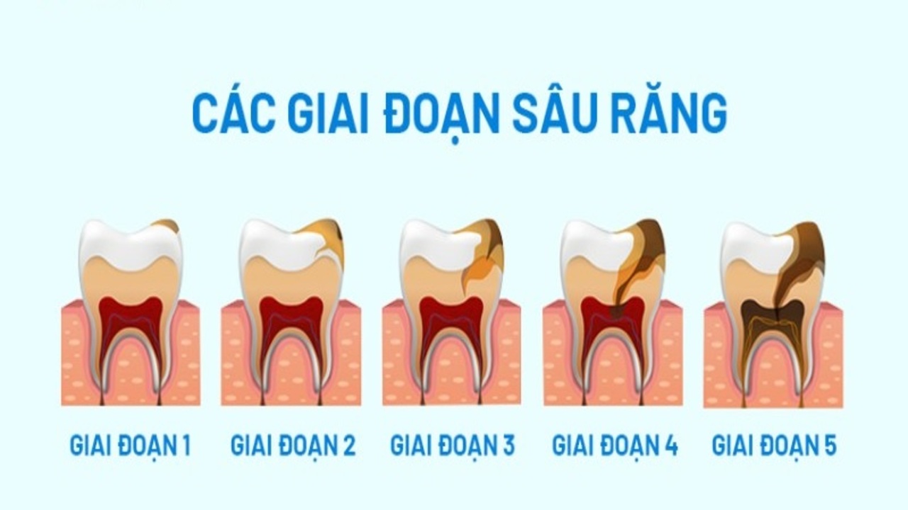 Các mức độ răng sữa bị sâu thường gặp