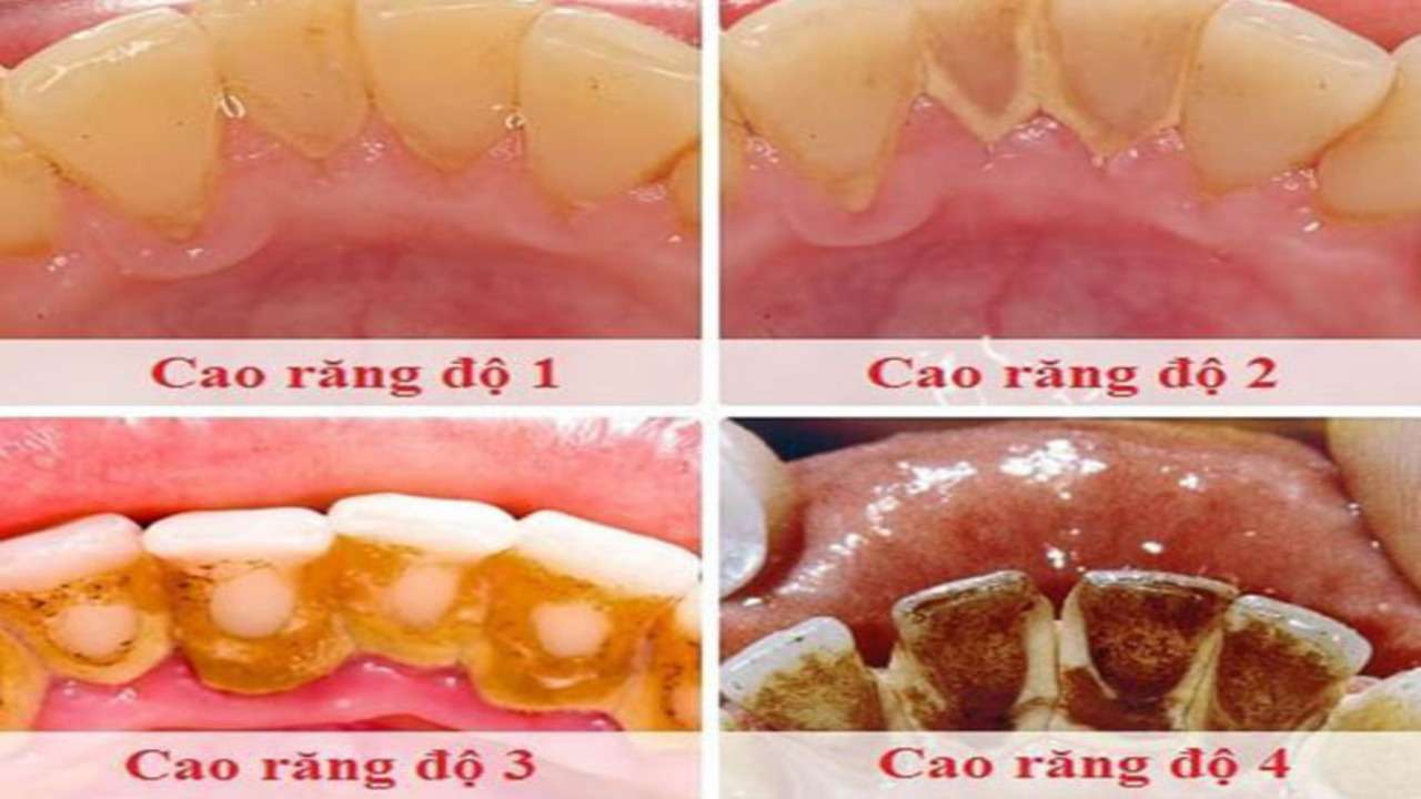 Dấu hiệu nhận biết cao răng