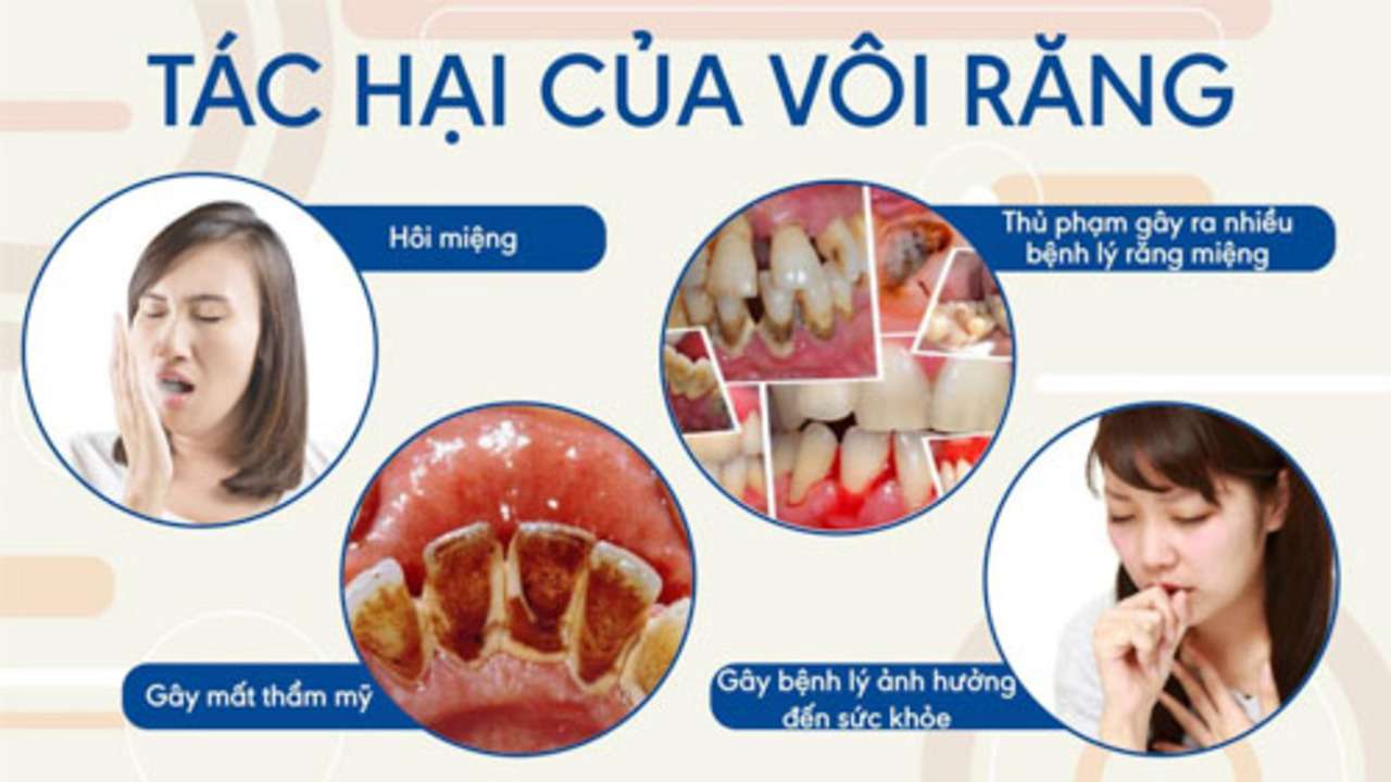 Tác hại của cao răng