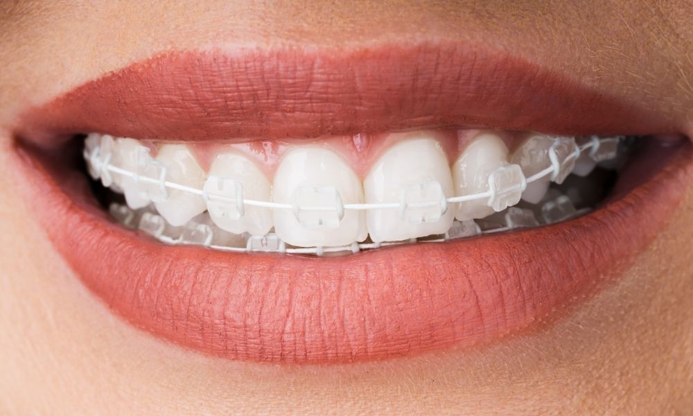 Nên niềng răng hay bọc sứ