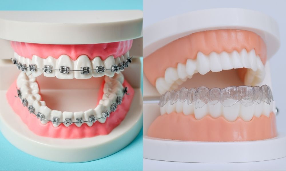 Nên niềng răng trong suốt hay mắc cài