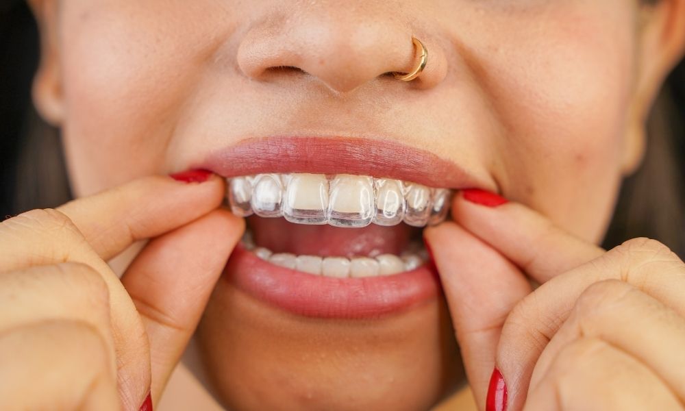 Nên niềng răng trong suốt hay mắc cài