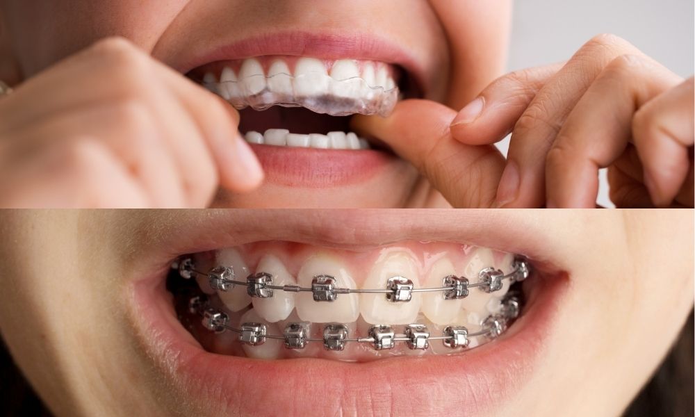 Nên niềng răng trong suốt hay mắc cài