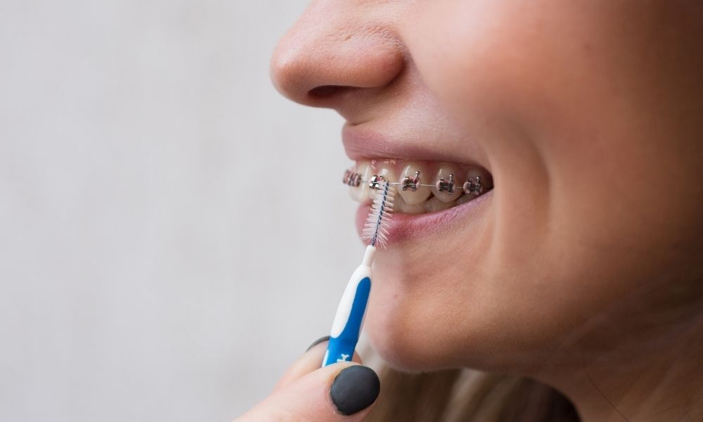 Nên niềng răng trong suốt hay mắc cài