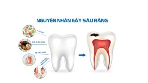 nguyên nhân gây ra sâu răng