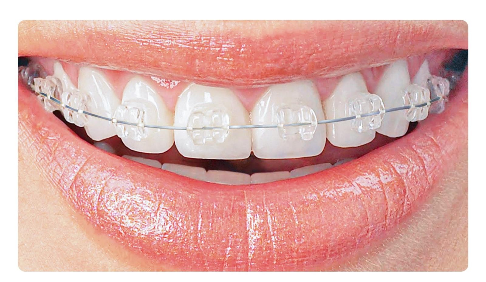 Phương pháp phổ biến nhất để chữa sai khớp cắn