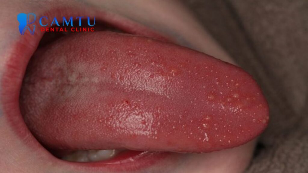 Nổi hạt ở cuống lưỡi
