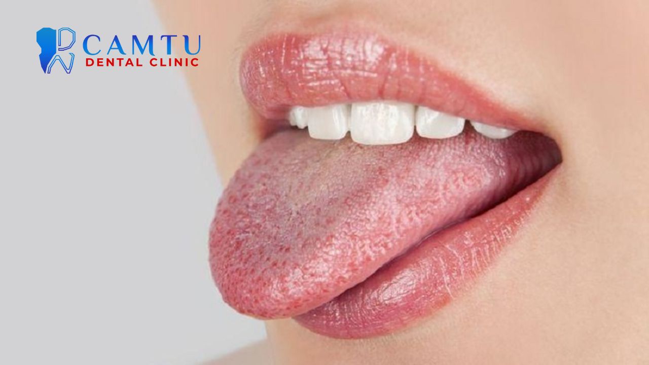 Nổi hạt ở cuống lưỡi