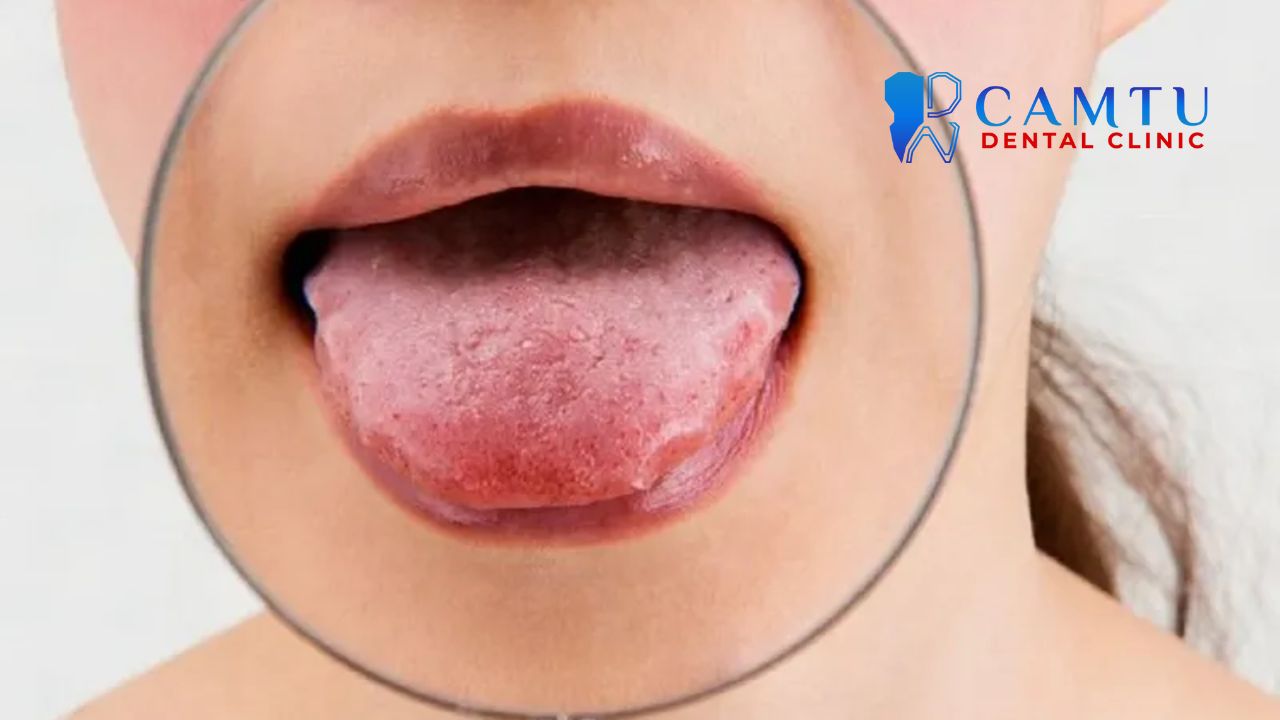 Nổi hạt ở cuống lưỡi