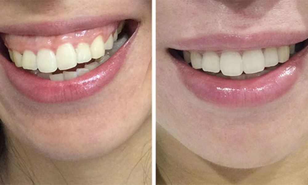 Phẫu thuật cắt lợi