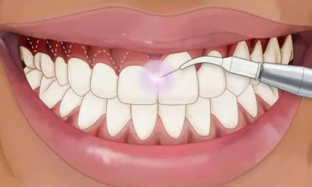 Phẫu thuật cắt lợi