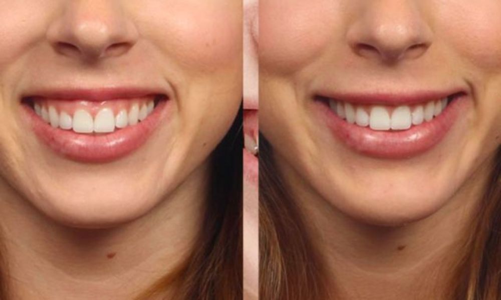 Phẫu thuật cắt lợi