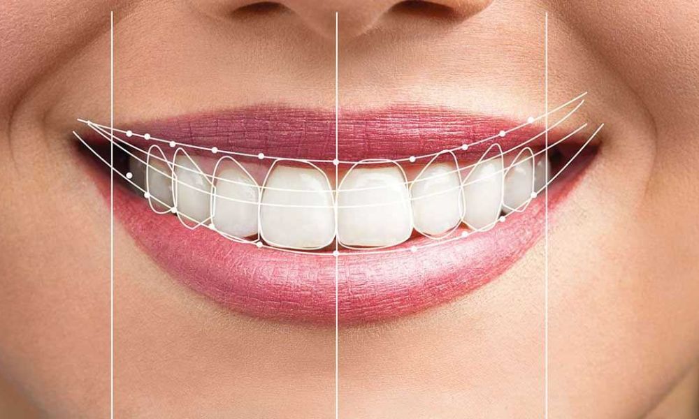 Phẫu thuật cắt lợi