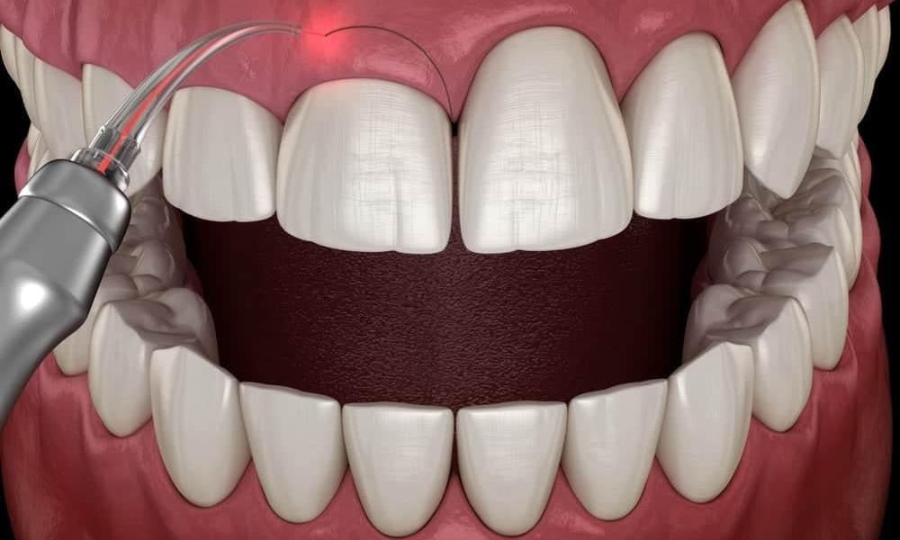 Phẫu thuật cắt lợi