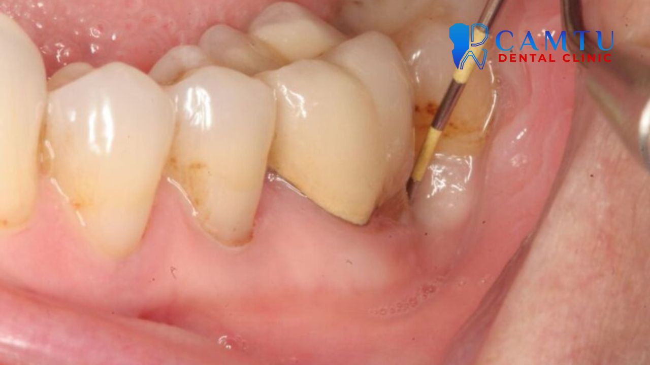 Phẫu thuật nha chu