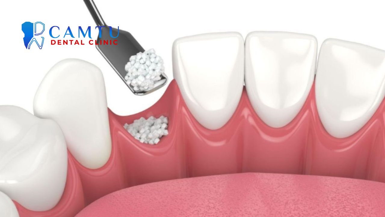 Phẫu thuật nha chu