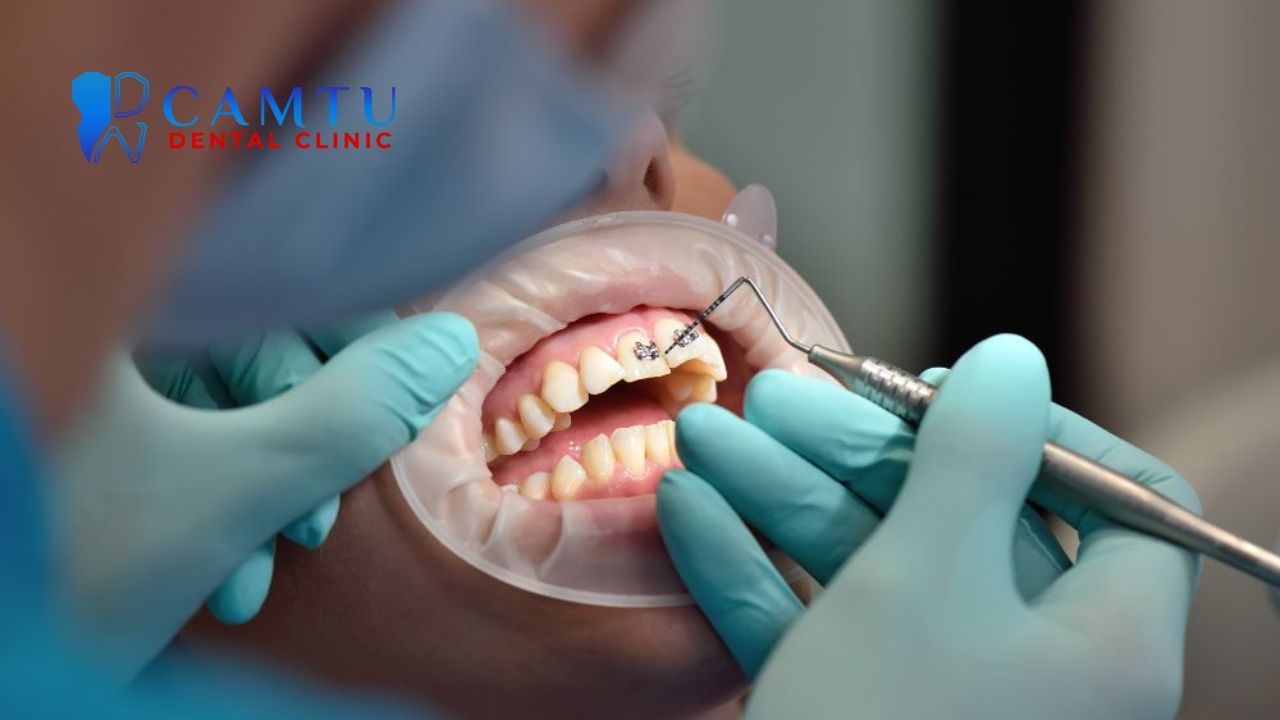 Răng hô nên niềng hay bọc sứ