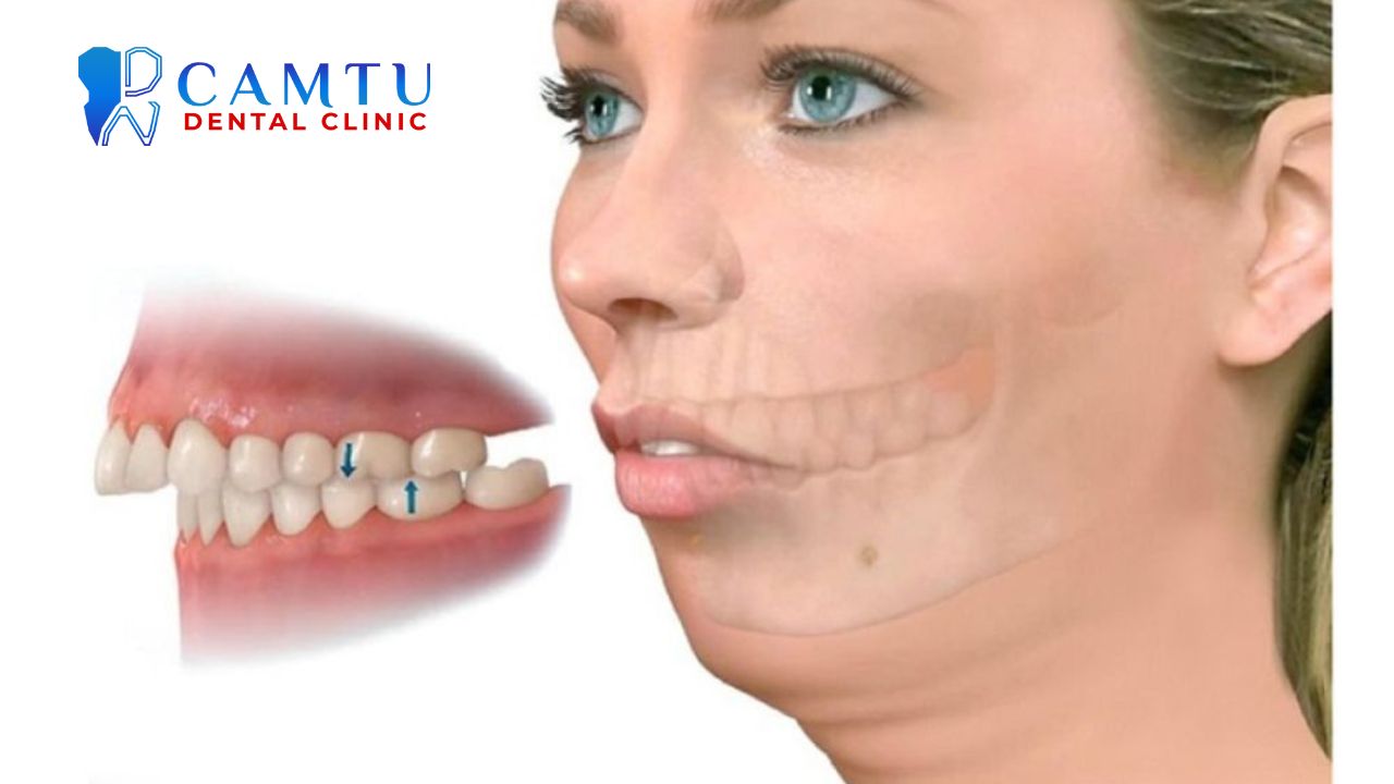 Răng hô nên niềng hay bọc sứ