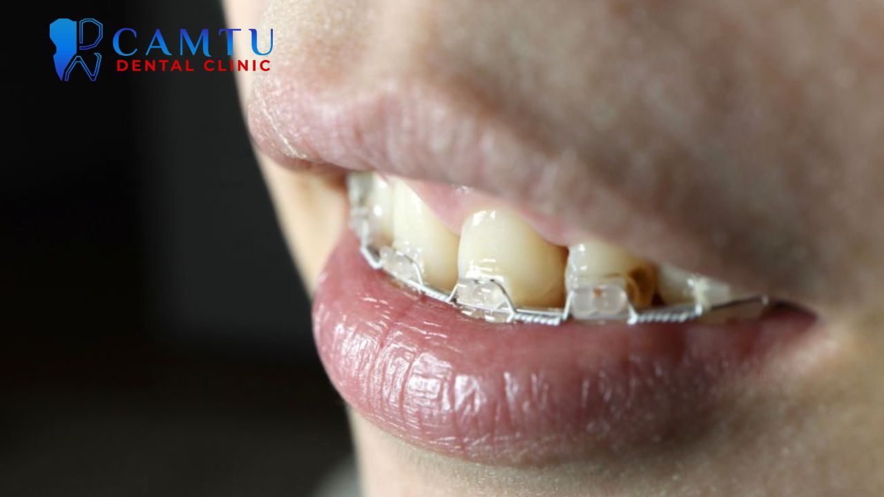 Răng hô nên niềng hay bọc sứ