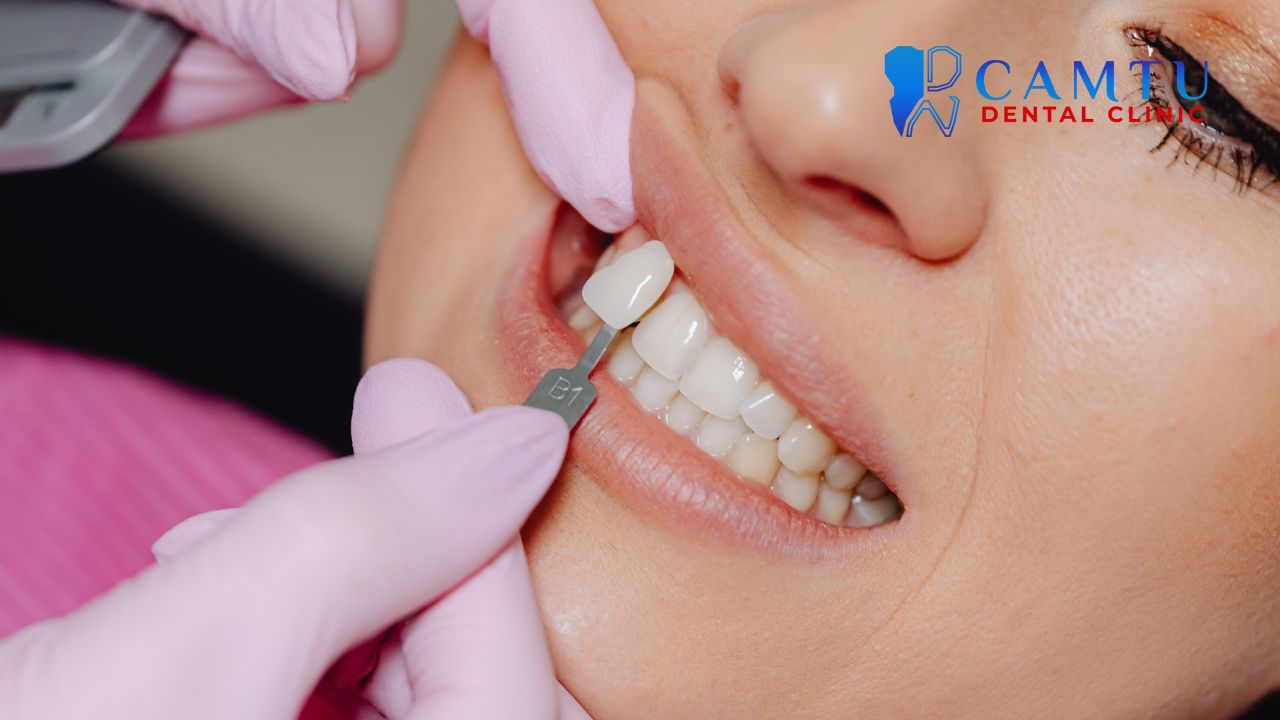 Răng hô nên niềng hay bọc sứ