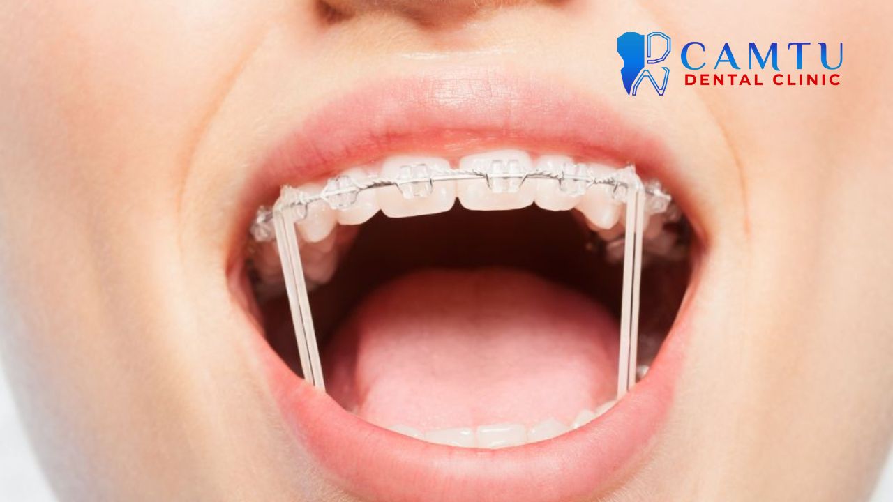 Răng hô nên niềng hay bọc sứ