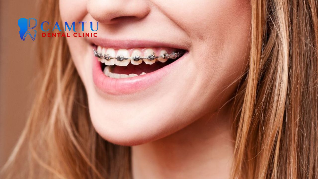 Răng hô nên niềng hay bọc sứ