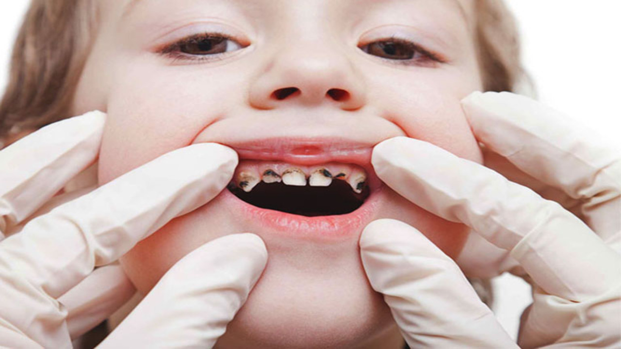 Dấu hiệu nhận biết răng sữa bị sâu ở trẻ