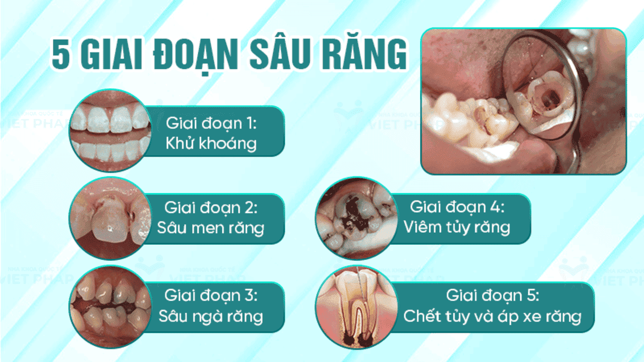 Cách điều trị răng sữa bị sâu theo từng mức độ