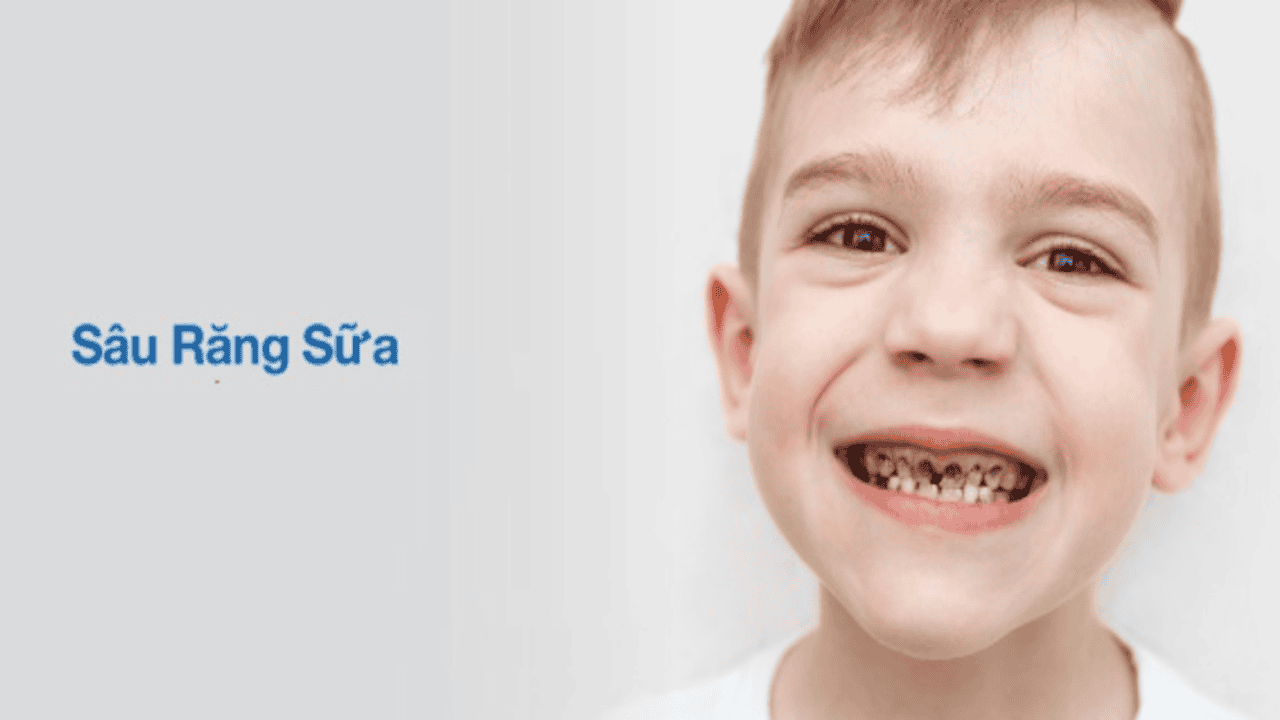 Dấu hiệu nhận biết răng sữa bị sâu ở trẻ