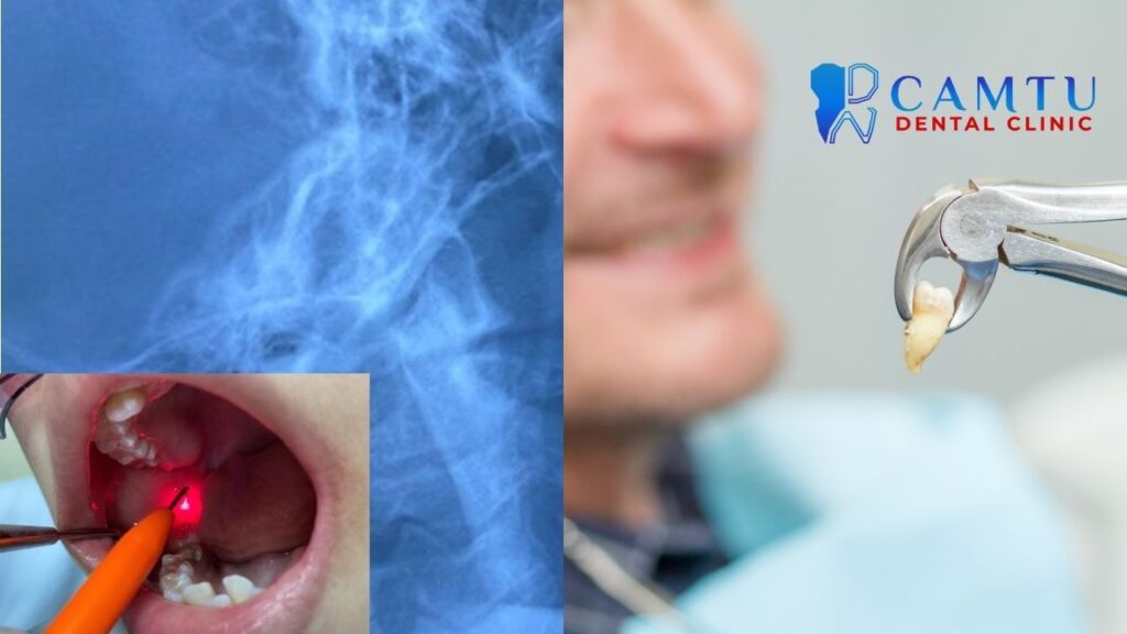 So sánh kỹ thuật nhổ răng khôn truyền thống và sử dụng laser