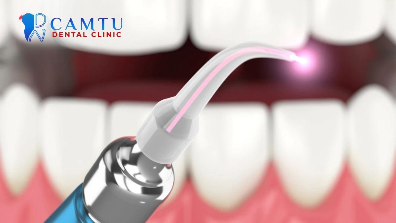 So sánh kỹ thuật nhổ răng khôn truyền thống và sử dụng laser