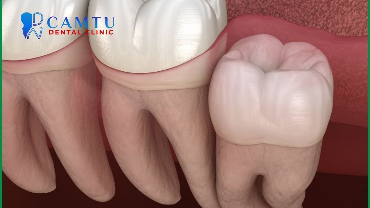 So sánh kỹ thuật nhổ răng khôn truyền thống và sử dụng laser