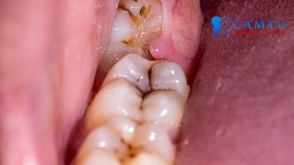 Sưng nướu răng khôn